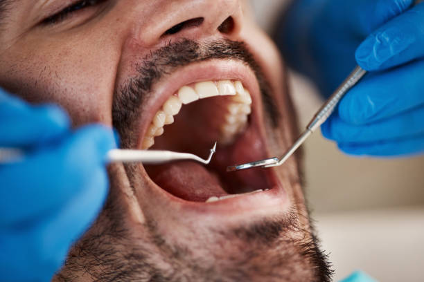 Best Emergency Dentist for Lost Fillings or Crowns in Knightdale, NC
