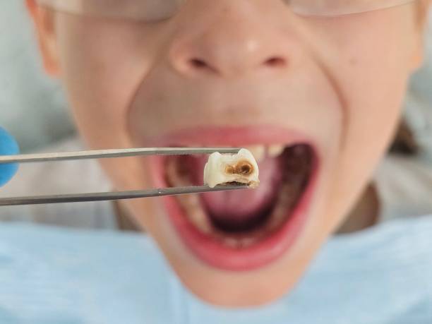 Best Emergency Dental Extractions in Knightdale, NC